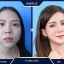 Nâng Mũi Thẩm Mỹ Kangnam